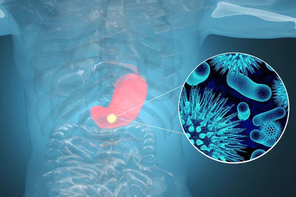 腫瘤標(biāo)記物CA72-4：“胃”，你還好嗎？